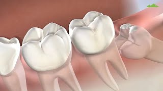 Wisdom Teeth Removal at Utah Surgical Arts