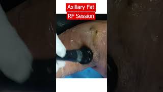 Get Rid of Armpit Fat | Underarm fat pad removal result #dressingremoval