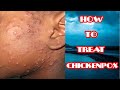 Chickenpox Treatment | How To Treat Chickenpox | Lifestyle & Home Remedies