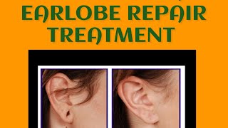 Non Surgical Earlobe Repair Treatment | Earlobe | Torn ear repair treatment