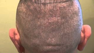 FUE Donor Scar Result 4000 Grafts on Caucasian Man Dr. Diep www.mhtaclinic.com California