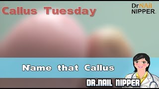 What are Toe Corns?   - Callus Tuesday #10