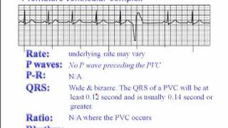 ECG: Premature Ventricular Complexes (PVC)