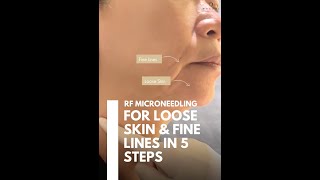 RF Microneedling for Fine Lines and Loose Skin | Ensoul Medical Clinic