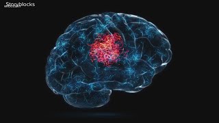 No, a brain hemorrhage is not always fatal