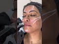 Harmonização Facial e Rejuvenescimento | Como tratar flacidez e rosto e caído