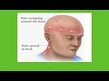 right side headache remedies and treatment