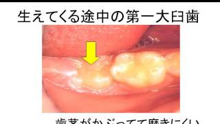 松阪市・津市・伊勢市　６歳臼歯の予防なら林歯科医院