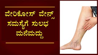 Home remedy for Varicose Veins |Vijay Karnataka