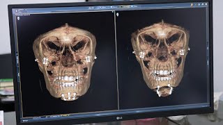 Redo or Revision Jaw Surgery - Before and After With Comparison of Scans