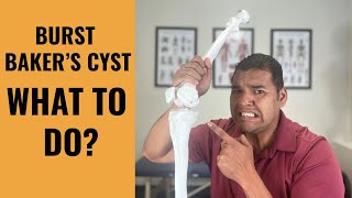 Baker’s Cyst Burst Help! - Why It Happens & What To Do Next