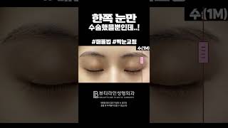 눈성형도 잘하는 뷰티라인! 짝눈교정도 뷰티라인성형외과 #reels #뷰티라인성형외과 #beforeandafter #짝눈교정 #눈매교정 #쌍수 #성형전후