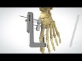 PROstep MIS Lapidus - Surgical Animation