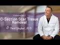 C-Section Scar Tissue Removal  | Procedure Part 1 | David Ghozland, M.D.