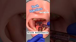 Block Anesthesia injection Video animation