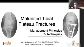 Dr Ashok Gavaskar - Malunited Tibial Plateau Fractures