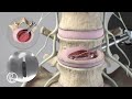 OptiLIF® Endo System - Spineology - 4K Animation