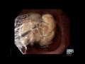 Endoscopic Management of Foreign Bodies in the Gastrointestinal Tract