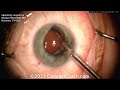 cataractcoach 1475 ascrs case 6 re fixating the iol