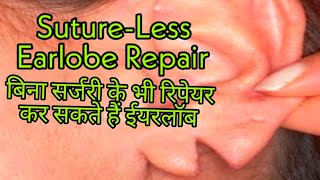 बिना सर्जरी कटे-फटे ईयरलॉब को जोड़ने का तरीका है ईयरलॉब रिपेयरिंग! ear hole closing without surgery.