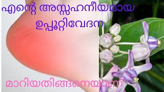 ഉപ്പൂറ്റിവേദന  അസഹനീയം,   അതിവേഗം ആശ്വാസം തരുന്ന അത്ഭുത ഒറ്റമൂലി