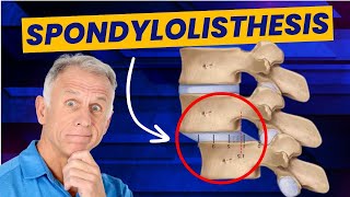 Spondylolisthesis: 4 Exercises to Reduce Pain (Demo on Real Patient)