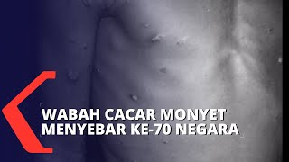 Wabah Cacar Monyet Menyebar di 70 Negara, Akankah Pandemi Baru ?