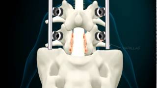 Laminectomia lumbar