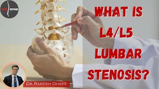 What is L4/L5 Lumbar Stenosis?