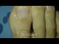 nail treatment progression photo before and after by fungal nail expert