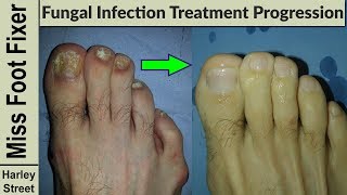 Nail Treatment Progression photo before and after by fungal nail expert