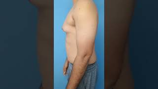 Gynecomastia Surgery Transformation | After liposuction, and gland removal.