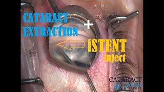 How to iStent: Cataract extraction w/ iStent Inject (MIGS)