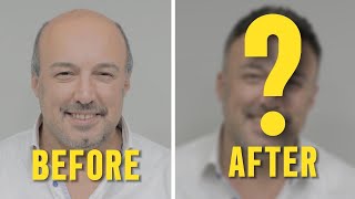 Protez Saç ile Mükemmel Değişim! - Hair Replacement