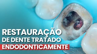 RESTAURAÇÃO DE DENTE TRATADO ENDODONTICAMENTE - Mylene e Renato