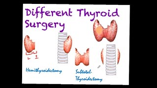 Types of Thyroid Surgery in 60 sec/Thyroid Surgery Animation