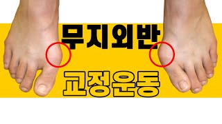 무지외반증에 도움 되는 교정운동