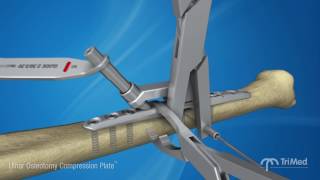 Ulnar Osteotomy Compression Plate Surgical Animation