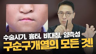 275화. 구순구개열수술의 모든것!!! 양측성,비대칭,흉터,구륜근