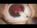 lens aspiration iol implantation and iol capture in a pediatric patients