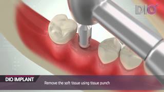 DIO 植牙 UFII System protocol