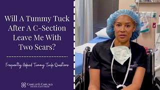 Will a Tummy Tuck get rid of my C-Section scar?