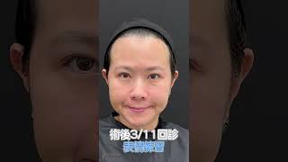 OL 上班女郎 掰掰 雙下巴嘴邊肉｜臉部微創抽脂｜呂佩璇醫師- 琢禾美學