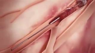 outoffears# Heart Stent video (Angioplasty)