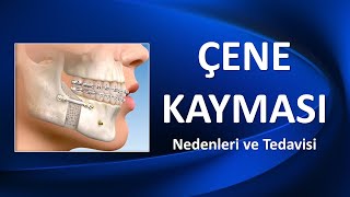 ÇENE KAYMASI Nedenleri ve Tedavisi