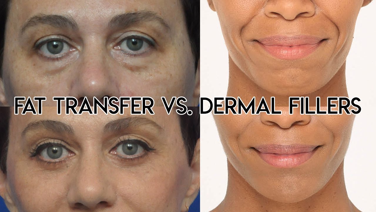 Facial Fillers Vs Fat Transfer At Josh Hayes Blog