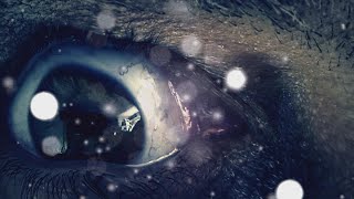 What Causes Visual Snow?