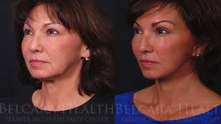 Dr. Bradley Robertson Discusses Facial Contouring (Short Version)