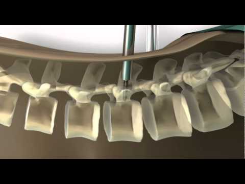 Spineassist Procedure Animation Wmv Youtube