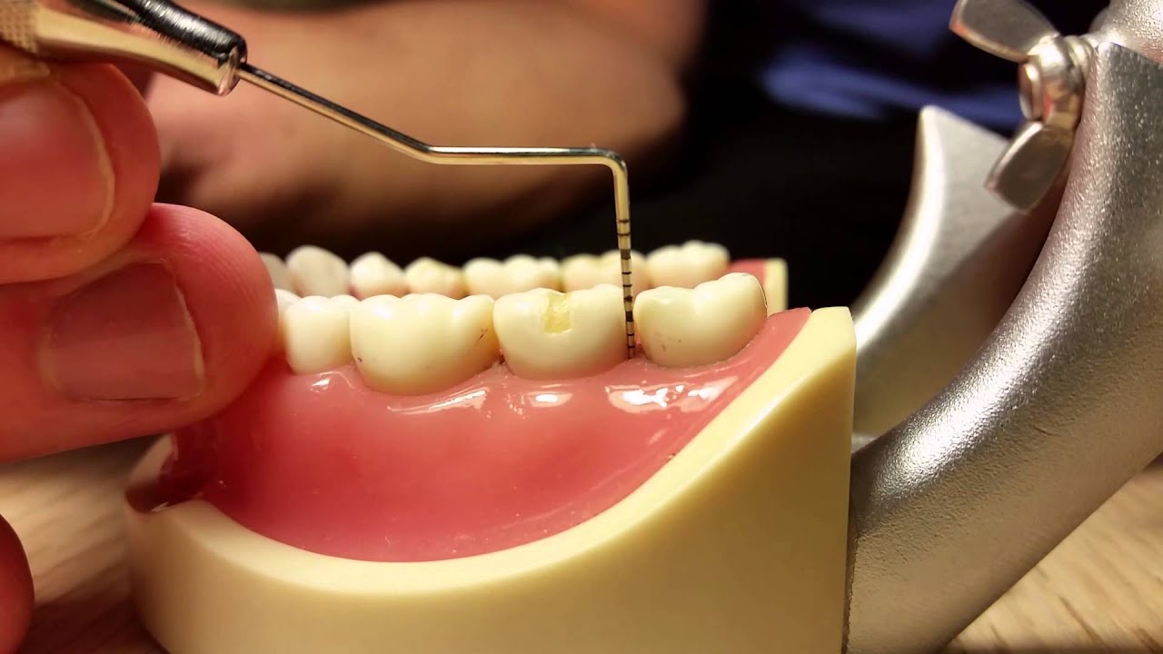 How To Use The Periodontal Probe - YouTube